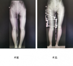 花季少女跛行15年，仁慈骨科利用Ilizarov技術(shù)幫其健康行走